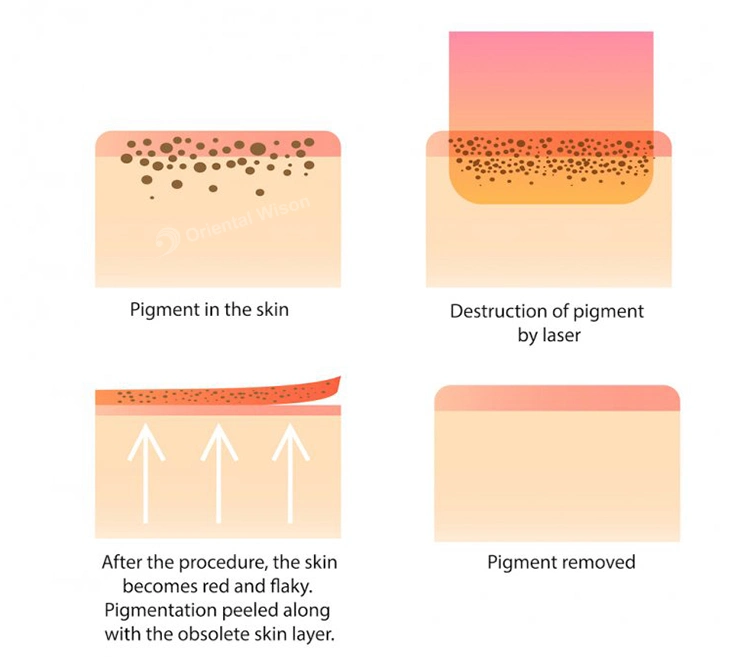 Picosecond Laser 755nm Tattoo Ink Pigment Removal Chlosma Melasma Removal Pico Laser Tattoo Ink Removal